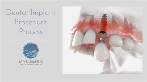 Why It Is Important To Understand And Plan A Dental Implant Procedure