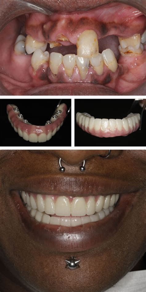 Full Mouth Dental Implants All On 6 Dental Implants Implant Dentist NYC