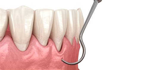 Pinhole Surgical Technique® Monroe Ct Gum Recession