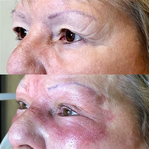 Fibroblast Plasma Skin Tightening Treatment North Carolina Izar