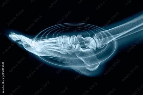 Foot pain on x-ray on black background Stock Photo | Adobe Stock