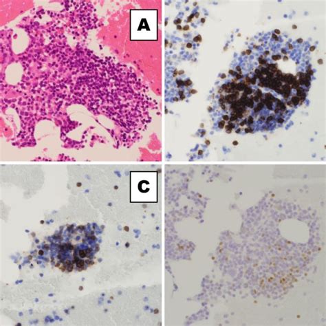 Figure2 Pathological Findings In The Bone Marrow Hematoxylin And Eosin