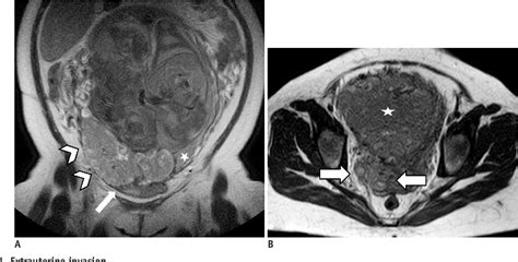 Figure 1 From Magnetic Resonance Imaging Of Placenta Accreta Spectrum A Step By Step Approach