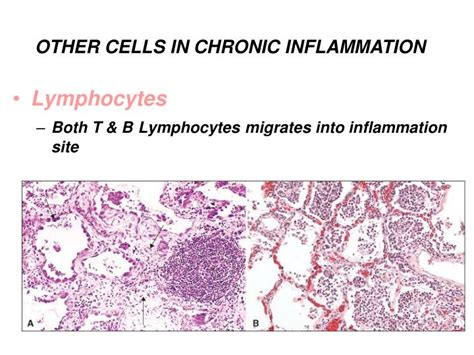 Ppt Inflammation And Repair Lecture 4 Chronic Inflammation Systemic