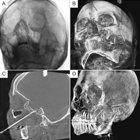 P 002 Flat Panel C Arm And Ct Guided Selective Trigeminal And