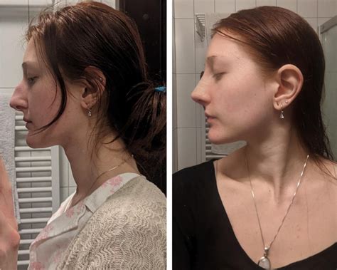 Before Vs Days Post Op Septo Rhinoplasty I Got My Cast Off Today