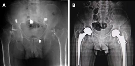 Figure From Low Velocity Simultaneous Bilateral Femoral Neck Fracture