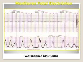 Monitoreo Fetal Dips Ppt