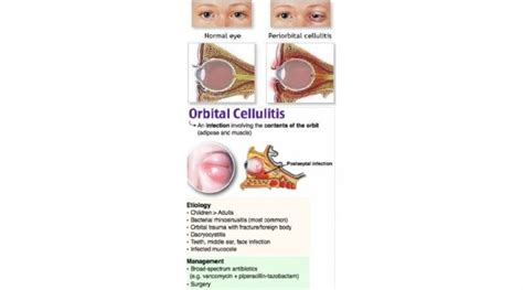 Preseptal Cellulitis Vs Orbital Cellulitis