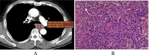 A 59 Year Old Male With Esophageal Squamous Cell Carcinoma ESCC A