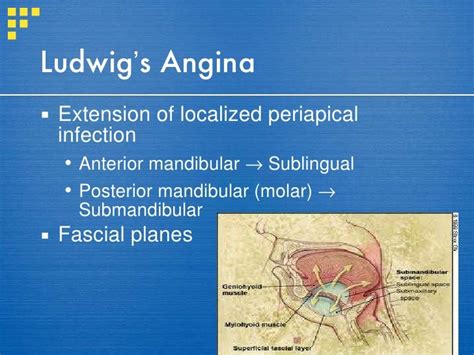 Ludwigs Angina And Anaesthetic Management