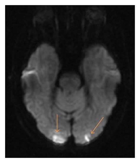 Acute Ischemic Infarct Mri Brain Dwi Sequences A Bilateral Download Scientific Diagram