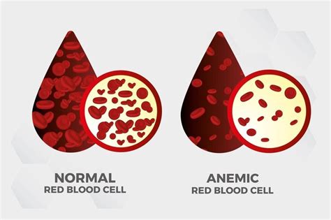 Understanding Anemia: Symptoms, Causes, and Treatment Option