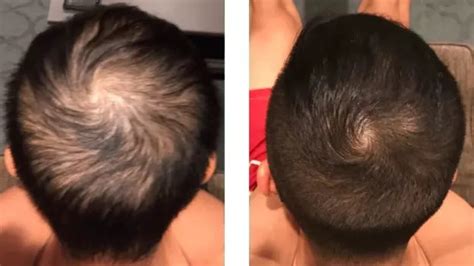 Minoxidil Before And After Photos [2024] Is It Right For You