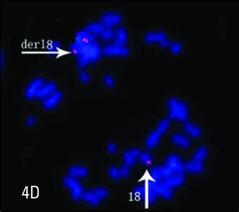 Prenatal Diagnosis And Molecular Cytogenetic Analysis Of A De Novo Isodicentric Chromosome 18