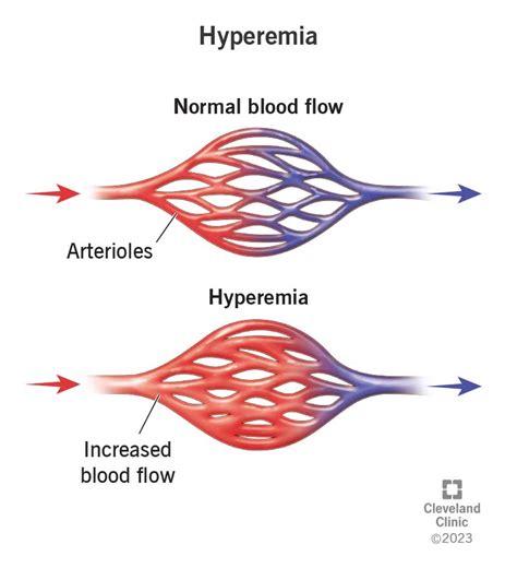 Hyperemia Causes Symptoms Treatment