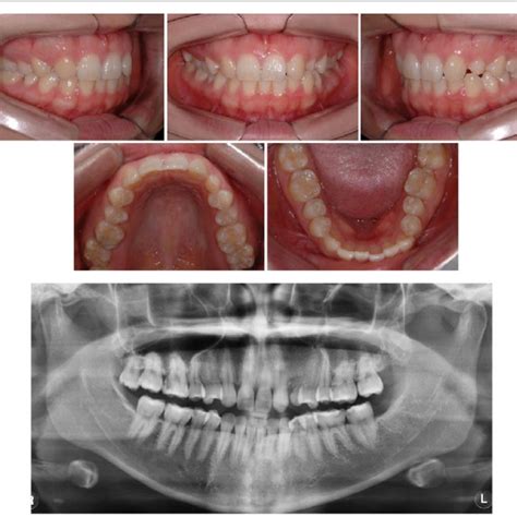 Pretreatment Intraoral Photographs And Panoramic Radiograph Download