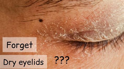 Dry Skin Around Eyes Disease