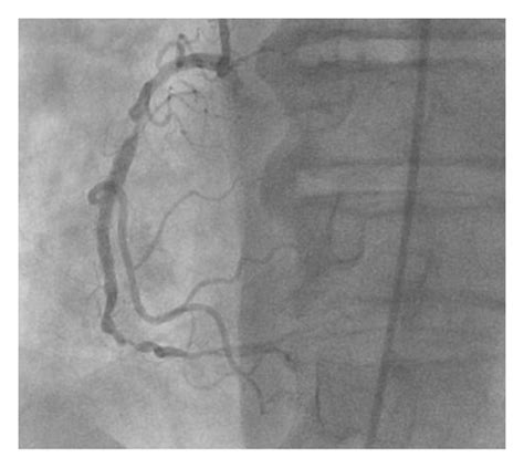 Coronary angiography showing near-complete occlusion of the RCA stent ...