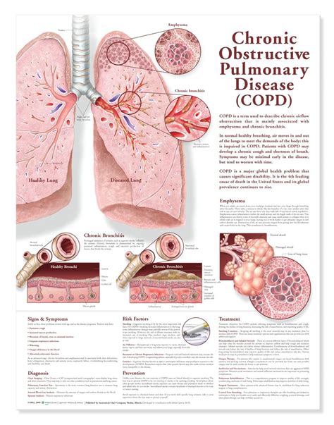 Chronic Obstructive Pulmonary Disease Copd Chart Poster Laminated