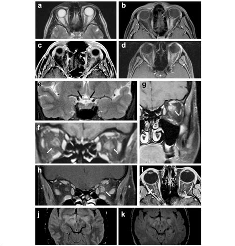 Examples of optic nerve lesions detected by MRI. a, b T2-weighted (a ...