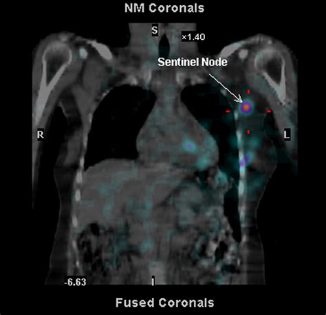 Sentinel Lymph Node Biopsy Information Dr Ben Lancashire