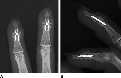 Retrospective Data Collection Of Distal Interphalangeal Joint Fusion