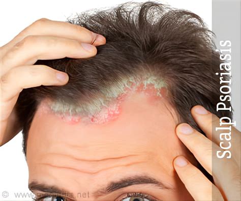 Mild Scalp Psoriasis Symptoms