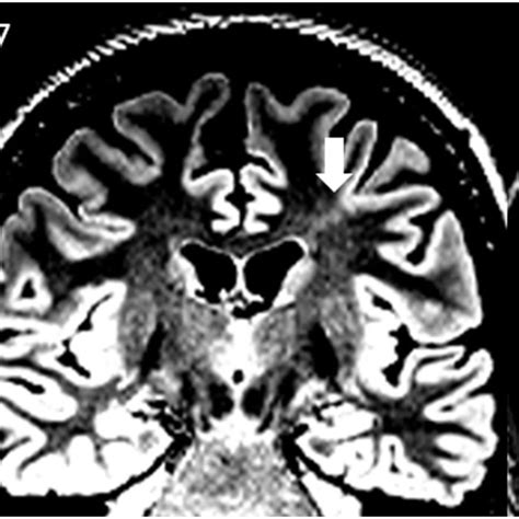 Illustrative Mri Examples From Bottom Of Sulcus Dysplasias Bos All