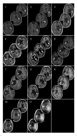 Lesion Location Structural Magnetic Resonance Images Mri