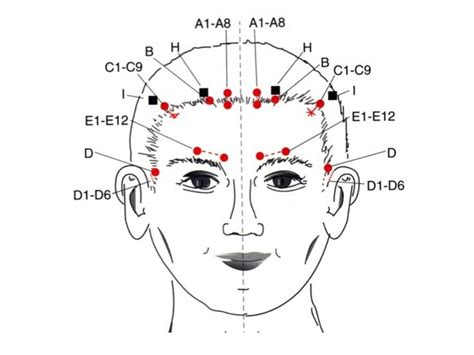 Craniopunturadeamamoto Blzdeaco Acupuncture Acupressure Treatment