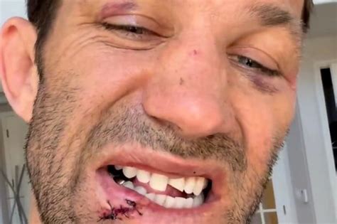 Former Ufc Champion Suffers Brutal Teeth Injury Following Loss In Bare