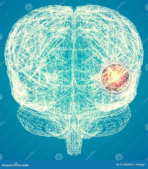 Sinapses De Derrame E Interação Neurônios Problemas Cerebrais