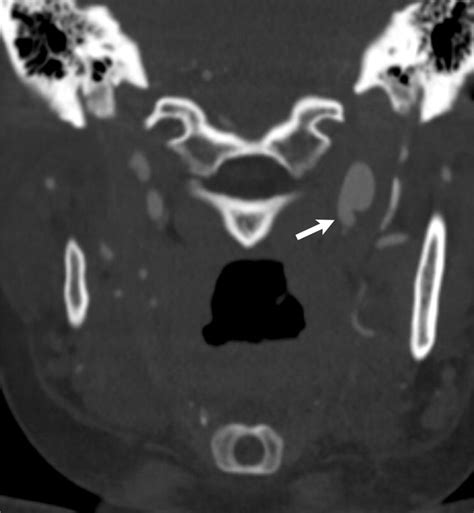 Role Of Coronary Ct Angiography In Spontaneous Coronary Artery