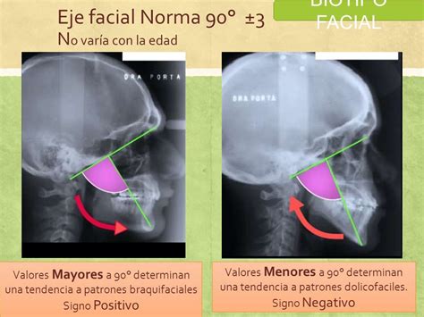 Biotipo Facial El Termino Biotiofacial Es Utilizado En Odontolog A