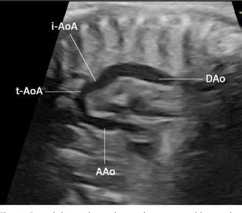 Figure From Prenatal Sonographic Features Of Cri Du Chat Syndrome A