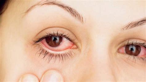 Con estos datos puedes reducir la irritación ocular o conjuntivitis