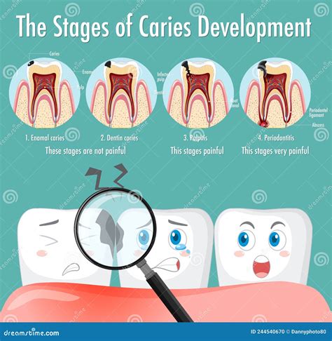 Stages Of Caries Development. Cartoon Vector | CartoonDealer.com #109546239