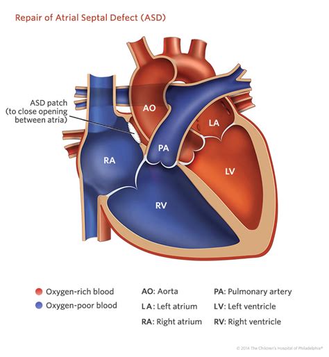 Atrial Septal Defect | Children's Hospital of Philadelphia