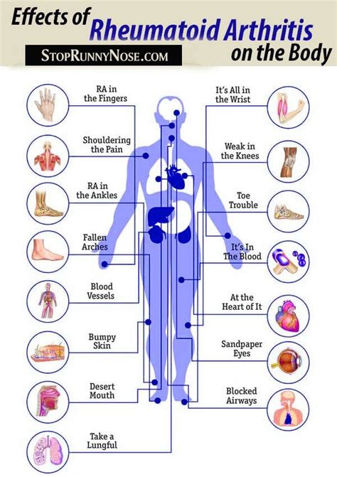 The 4 Stages Of Rheumatoid Arthritis Progression Artofit