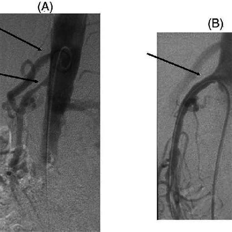 Selective SMA (arrow 1) angiogram: contrast lls the marginal artery... | Download Scientific Diagram