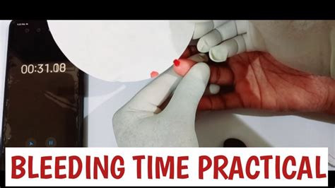 Determination Of Bleeding Time By Dukes Method Practical Video YouTube