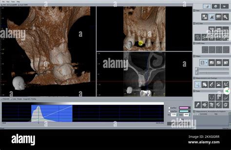 Radiography Dental Scan Stock Videos Footage Hd And K Video Clips