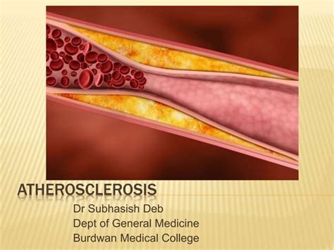 Atherosclerosis Ppt