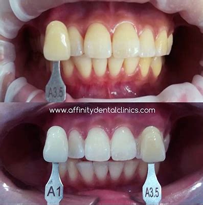 Teeth Color Chart A Jada Headrick