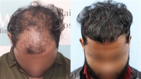 Best Hair Transplant Result 2021 Diffuse Pattern 3305 Grafts Regrow Clinic Haridwar