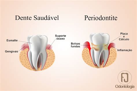 Gengivite Doi O Dente