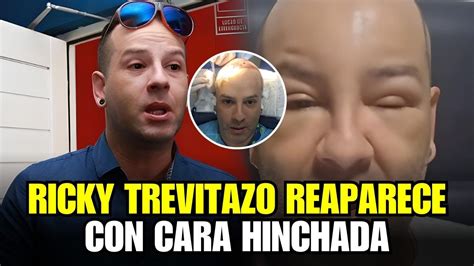 Ricky Trevitazo Reaparece Con Cara Hinchada Y Preocupa A Sus Fans ¿que