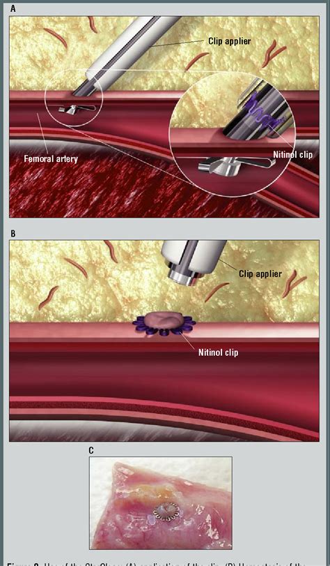 Femoral Catheterization