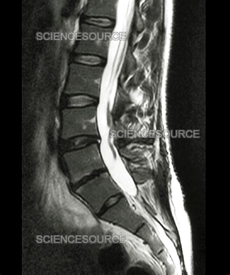 Spinal Arachnoiditis Mri Stock Image Science Source Images